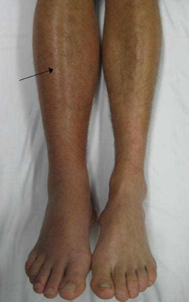 varicele extremităților inferioare pot perturba doar un picior